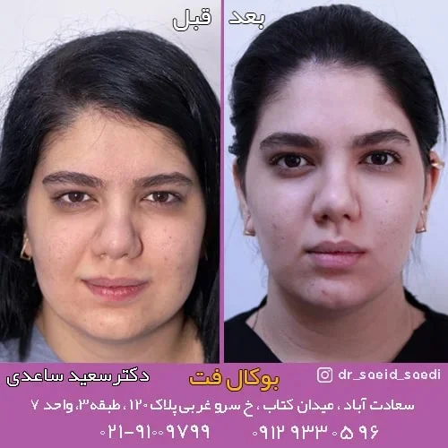 آیا عمل بوکال فت عوارض دارد؟