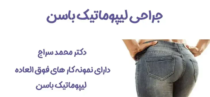 اصفهان لیپوساکشن باسن در اصفهان: کاهش چربی های موضعی با جدیدترین تکنیک ها