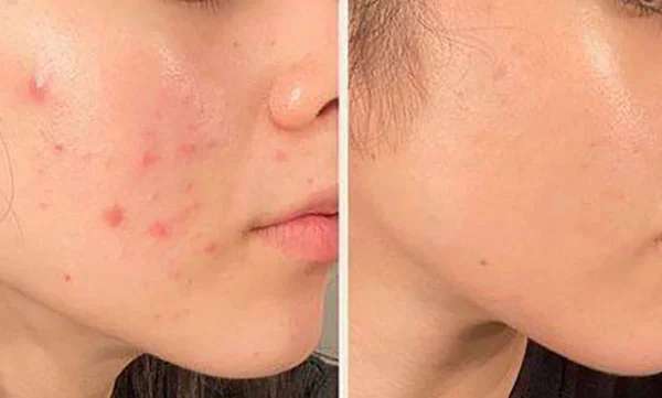  حساسیت پوستی و درمان با روغن های گیاهی