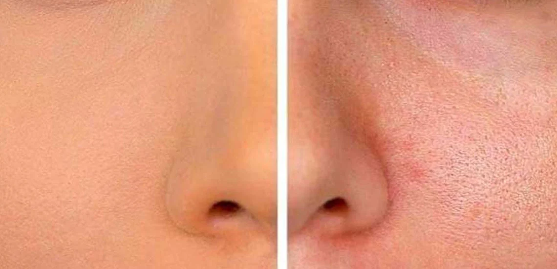 پوست روش های خانگی برای داشتن پوستی صاف و بدون منافذ