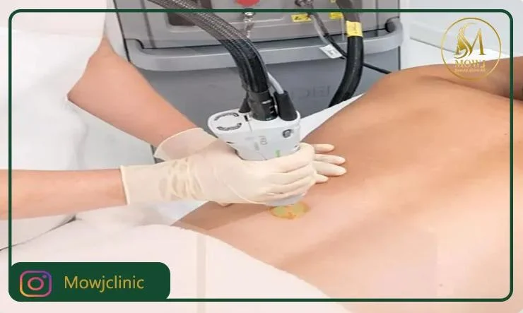 کلینیک زیبایی موج؛ خدمات حرفه ای لیزر موهای زائد مردان و لیزر ناحیه تناسلی مردان با دستگاه های روز دنیا