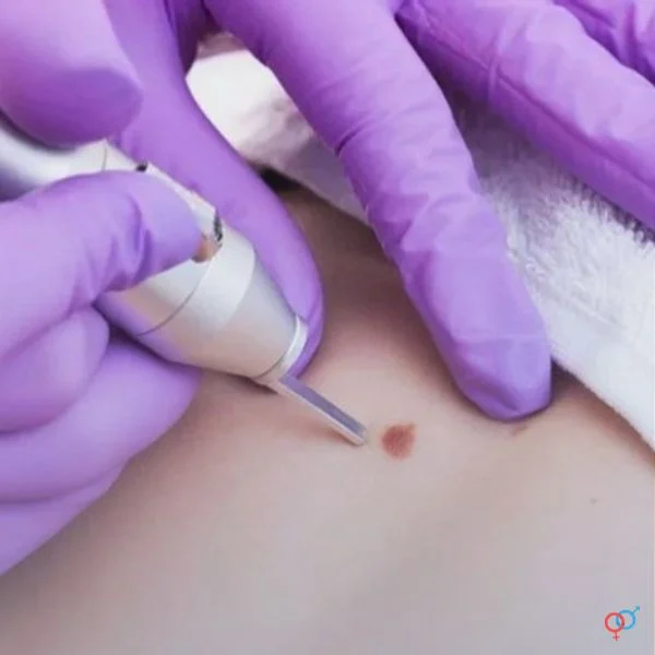 پوست روش انجام لیزر زگیل تناسلی چگونه است؟